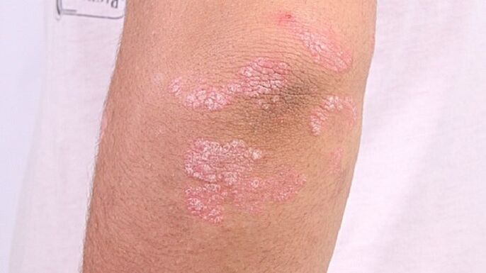 Foto vun fréi Stuf Psoriasis