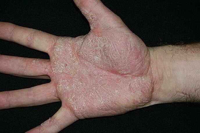 Psoriasis vun den Handflächen a Féiss