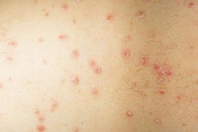 Symptomer vun Flecken Psoriasis
