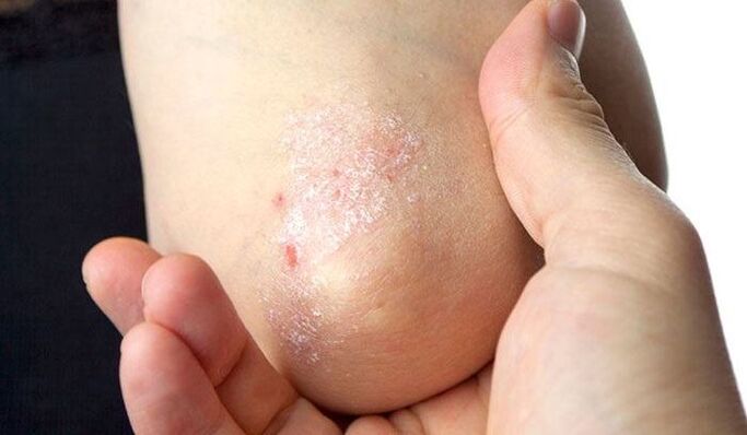 Symptomer vun der Psoriasis an der éischter Etapp