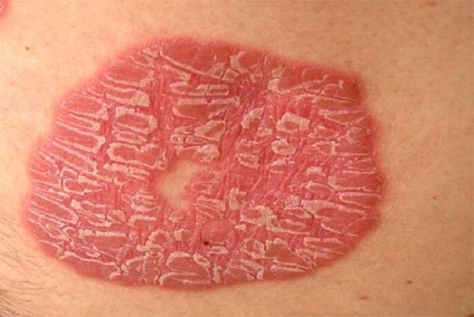 pustulär Psoriasis