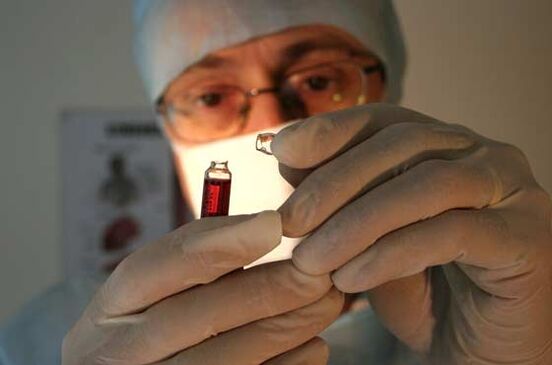 Ursaachen vum Psoriasis Dokter