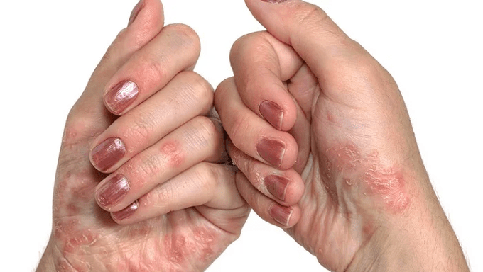 initial Etapp vun der Psoriasis