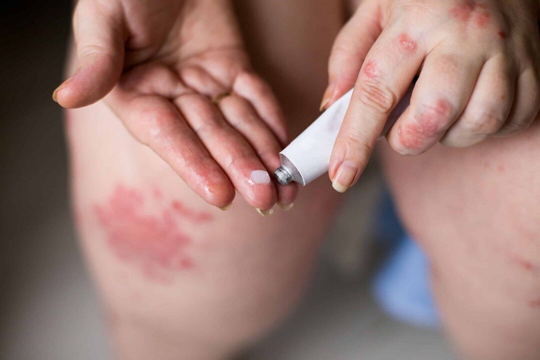 Behandlung vun Psoriasis