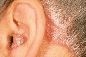 Ursaachen vun Psoriasis