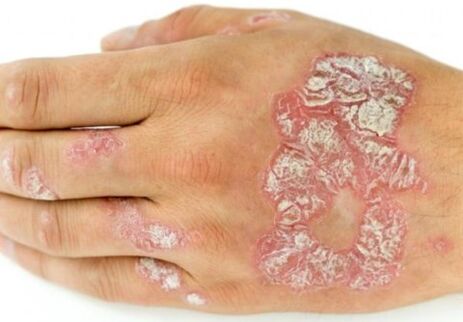 psoriasis op der Hand