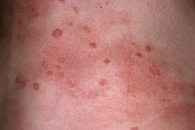 Foto vu Psoriasis op der Haut